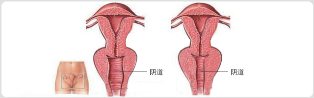阴道紧缩(图1)